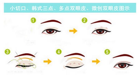 欧式大平行双眼皮貌似成为主流?看看你合不合