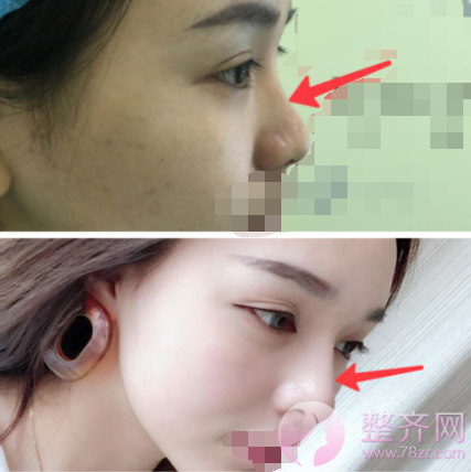 膨体需要5到10年更换一次?