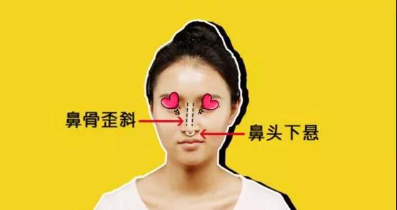 花大价钱隆鼻却成歪鼻,紧急求助……