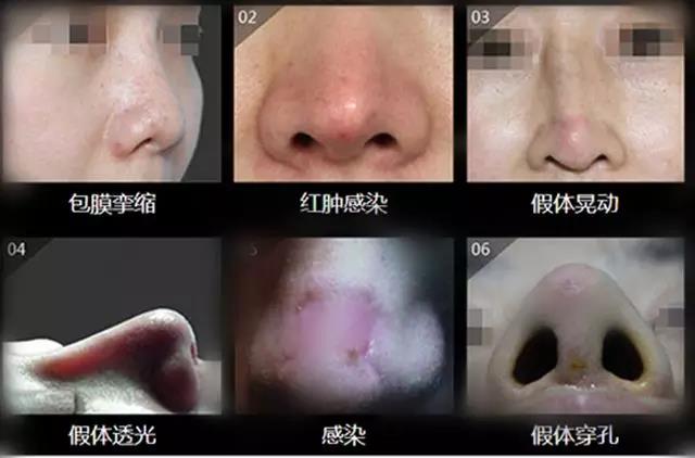 花大价钱隆鼻却成歪鼻,紧急求助……