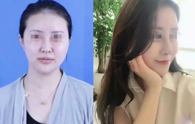 花大价钱隆鼻却成歪鼻,紧急求助……