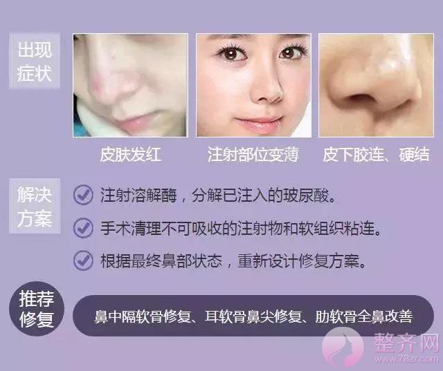 你的鼻整形失败了还有救吗?