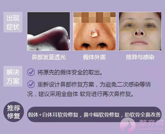 你的鼻整形失败了还有救吗?
