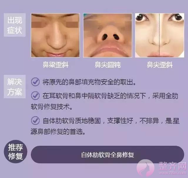 你的鼻整形失败了还有救吗?