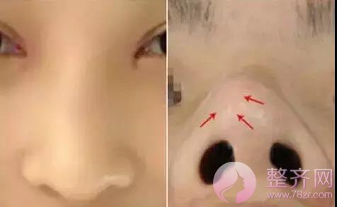 你的鼻整形失败了还有救吗?