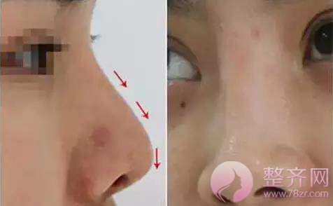 你的鼻整形失败了还有救吗?