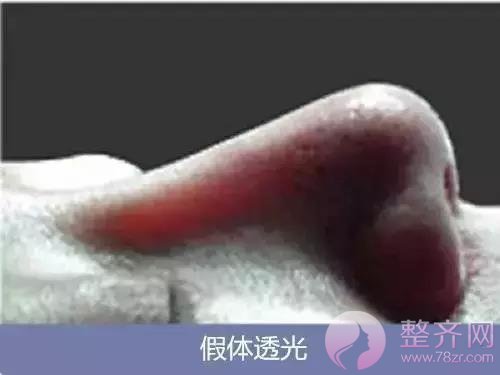 你的鼻整形失败了还有救吗?
