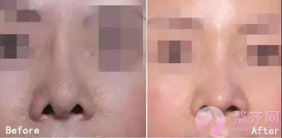 你的鼻整形失败了还有救吗?