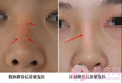 你的鼻整形失败了还有救吗?