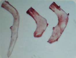 关于自体肋软骨隆鼻,它到底有多可怕?