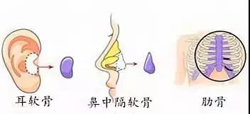 关于自体肋软骨隆鼻,它到底有多可怕?