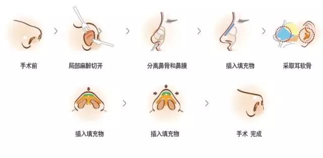 关于自体肋软骨隆鼻,它到底有多可怕?