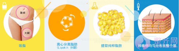 浅谈自体脂肪移植技术!