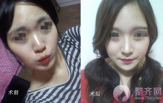北京韩式硅胶隆鼻案例,改变不止一点点