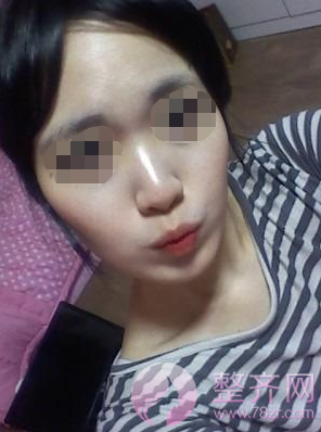 北京韩式硅胶隆鼻案例,改变不止一点点