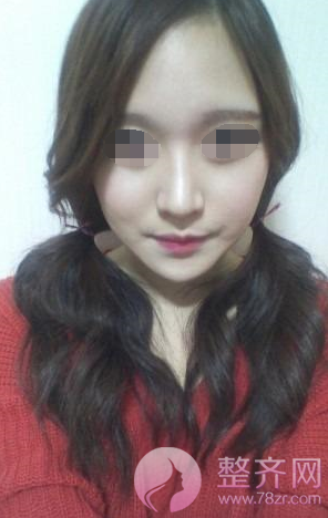 北京韩式硅胶隆鼻案例,改变不止一点点
