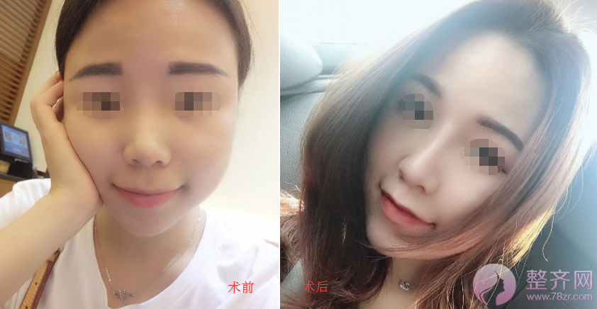 武汉鼻部手术术后半年案例分享