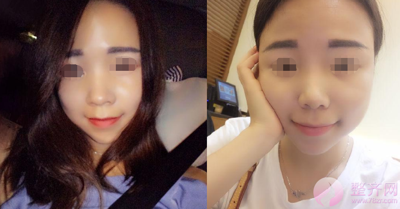 武汉鼻部手术术后半年案例分享