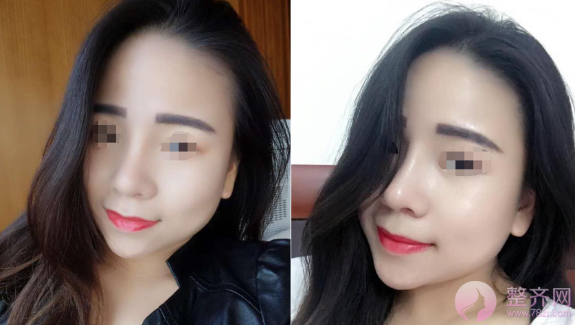武汉鼻部手术术后半年案例分享