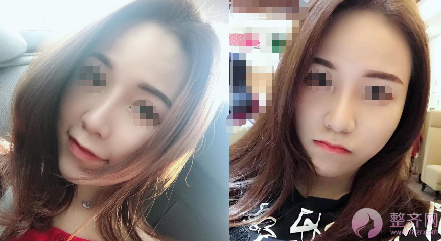 武汉鼻部手术术后半年案例分享
