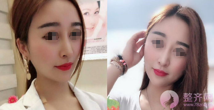 广州自体脂肪全脸填充案例