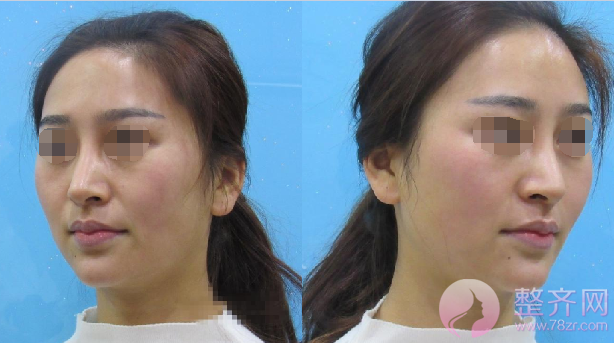 广州自体脂肪全脸填充案例