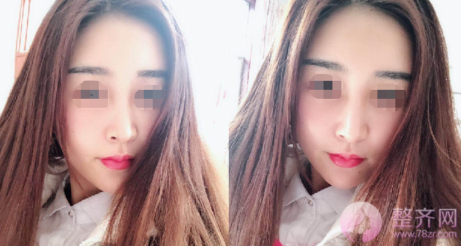 广州自体脂肪全脸填充案例