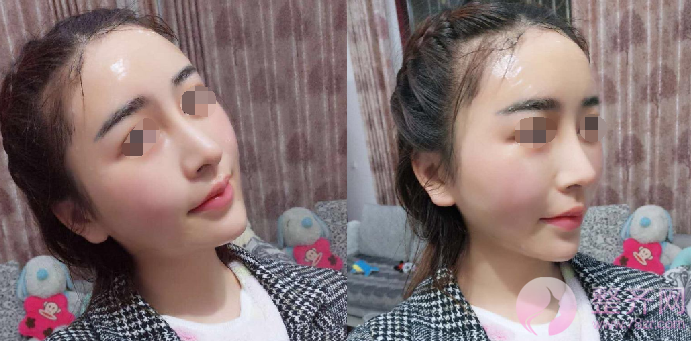 广州自体脂肪全脸填充案例