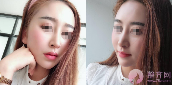广州自体脂肪全脸填充案例