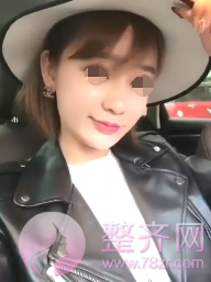 深圳自体脂肪面部填充案例