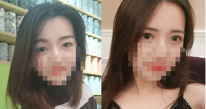 上海双眼皮+开内眼角案例术后分享