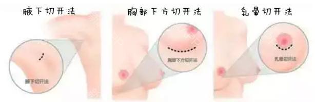 假体隆胸 &自体脂肪隆胸,该怎么选呢?