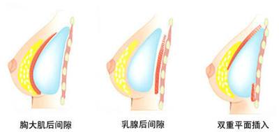 假体隆胸 &自体脂肪隆胸,该怎么选呢?