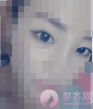 北京全切双眼皮案例术后3个月分享