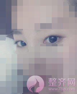 北京全切双眼皮案例术后3个月分享