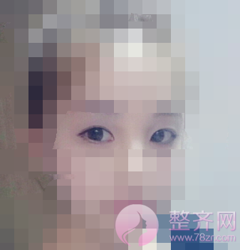 北京全切双眼皮案例术后3个月分享