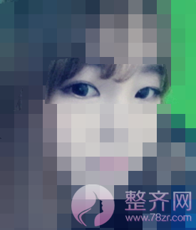 北京全切双眼皮案例术后3个月分享