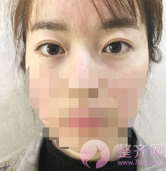 重庆双眼皮案例分享