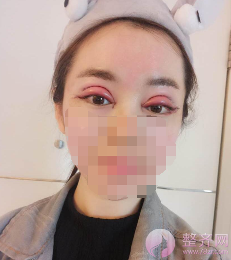 重庆双眼皮案例分享