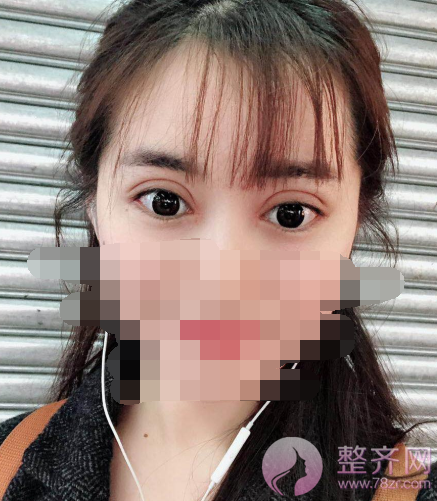 重庆双眼皮案例分享