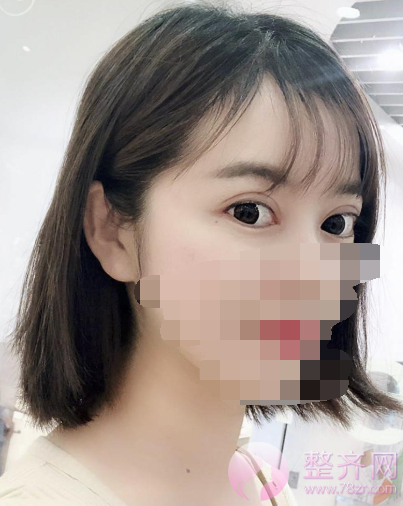 重庆双眼皮案例分享