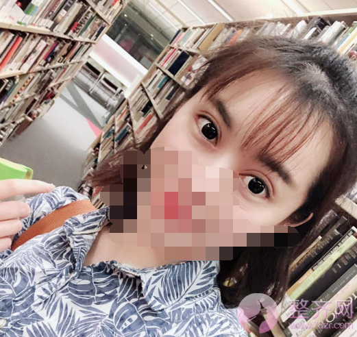 重庆双眼皮案例分享