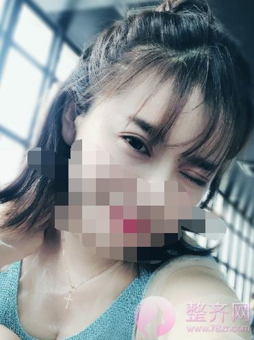 重庆双眼皮案例分享