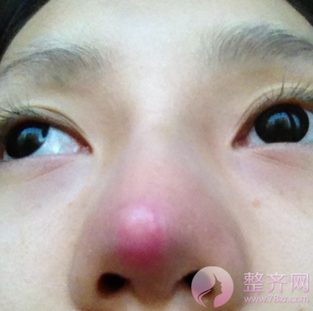 进行假体隆鼻术后,鼻尖为何发红?