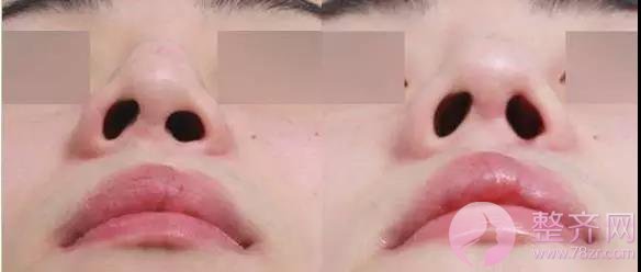 进行假体隆鼻术后,鼻尖为何发红?