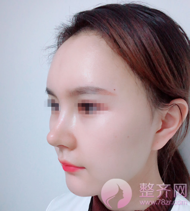 成都硅胶隆鼻案例术后50天
