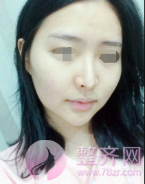 浙江自体脂肪全脸填充术后60天