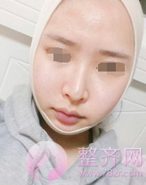 浙江自体脂肪全脸填充术后60天