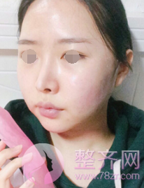 浙江自体脂肪全脸填充术后60天