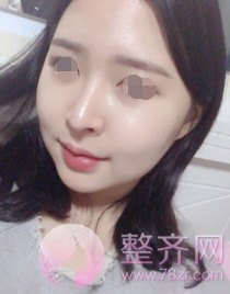 浙江自体脂肪全脸填充术后60天